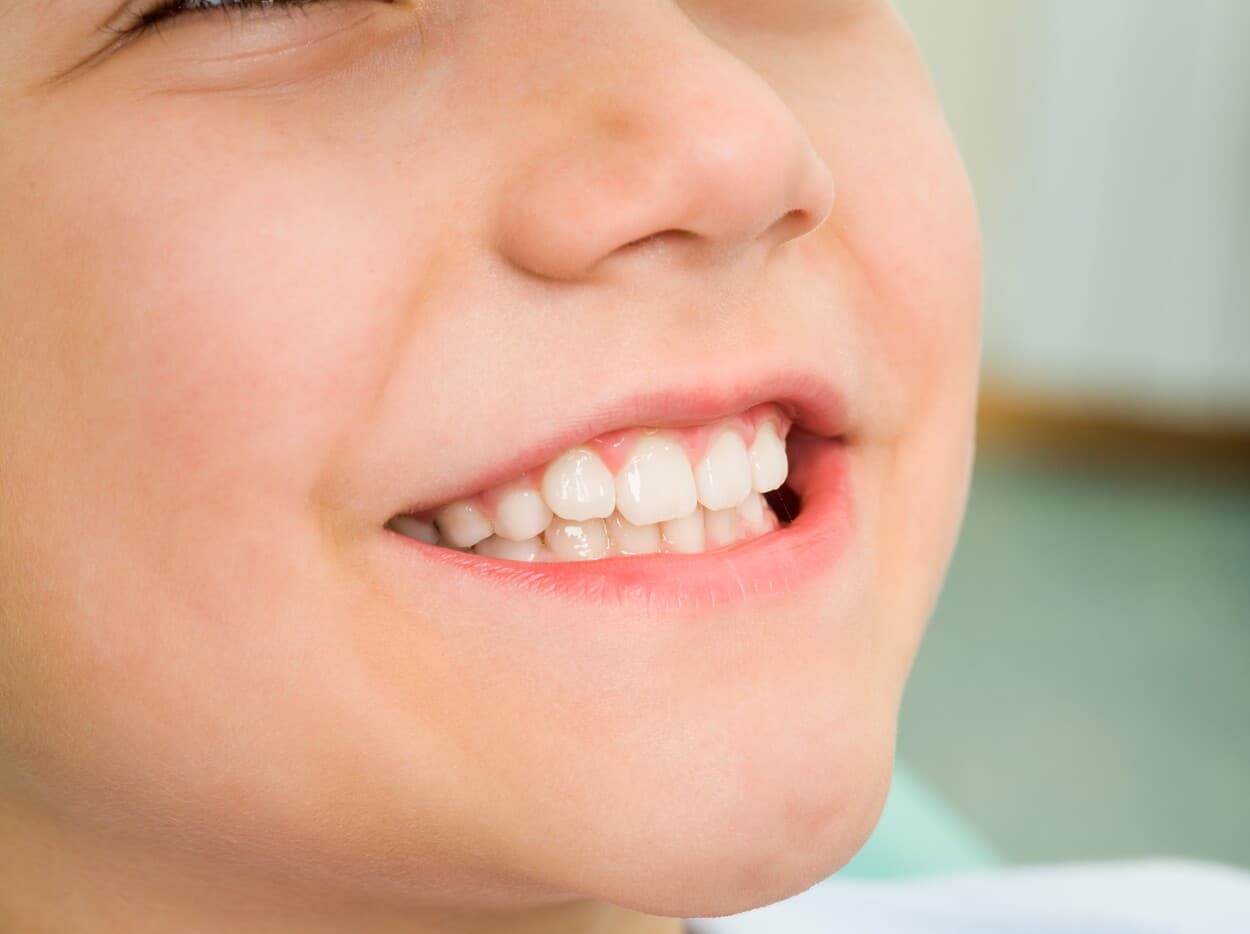 Sobremordida en niños