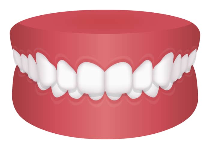 Tipo de sobremordida