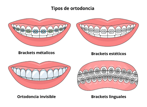 tipos de ortodoncia